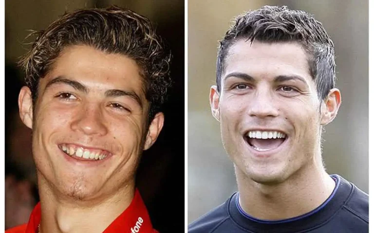 Before and After Cristiano Ronaldo Plastic Surgery Journey!