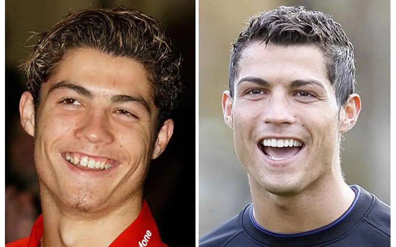 Before and After Cristiano Ronaldo Plastic Surgery Journey